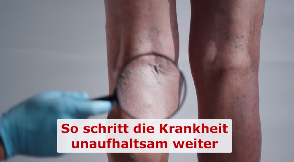 Legs without Nervixol